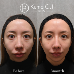 裏evoリフト法＋ほうれい線prp